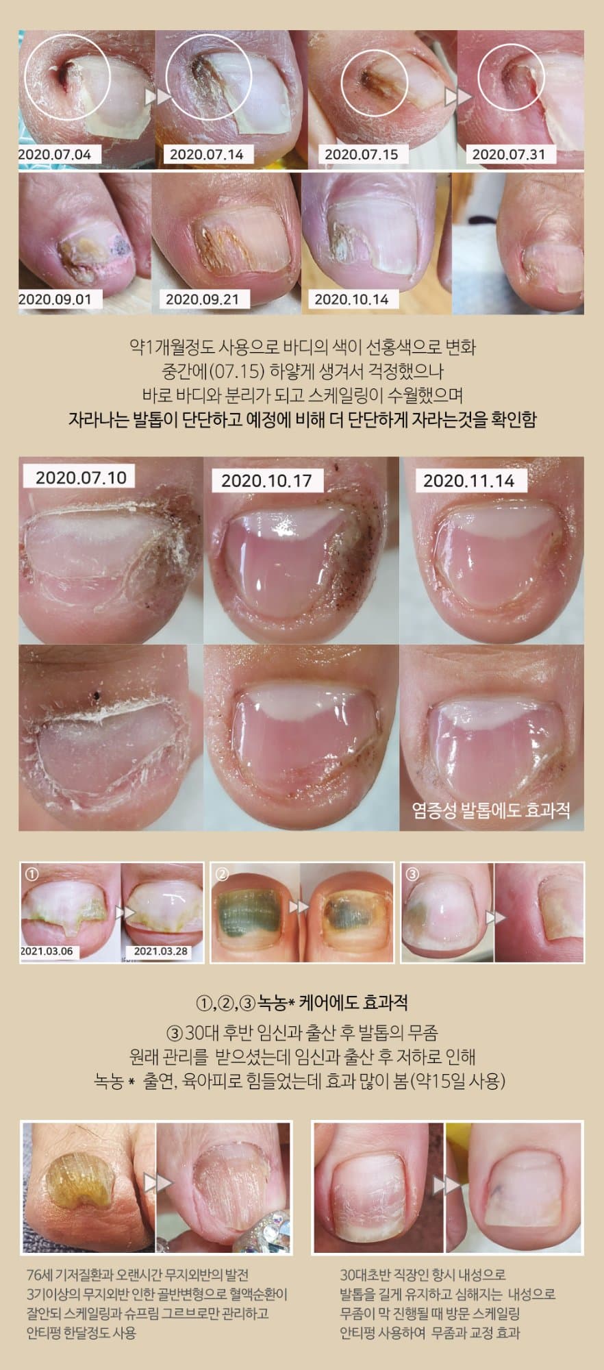 뷰젤 안티펑 5ml 손발톱 영양제 손톱강화제 네일 세럼
