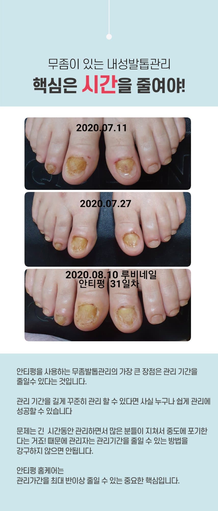 뷰젤 안티펑 5ml 손발톱 영양제 손톱강화제 네일 세럼