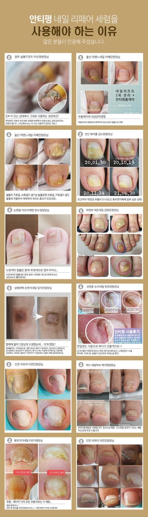 뷰젤 안티펑 5ml 손발톱 영양제 손톱강화제 네일 세럼