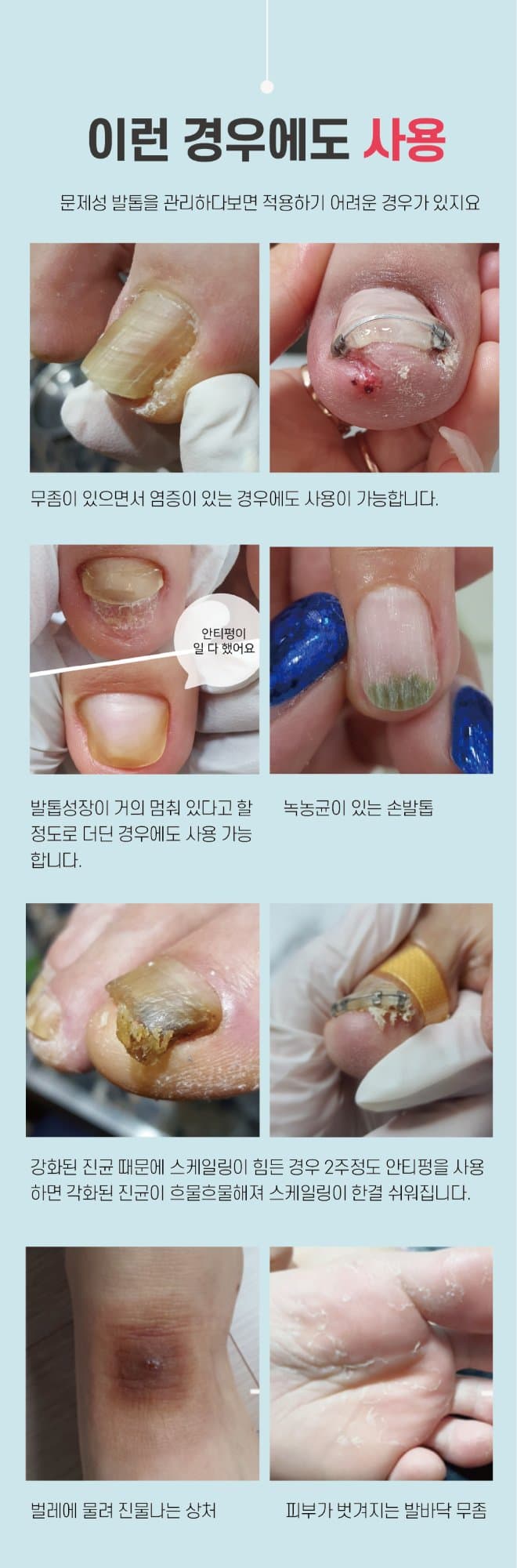 뷰젤 안티펑 5ml 손발톱 영양제 손톱강화제 네일 세럼